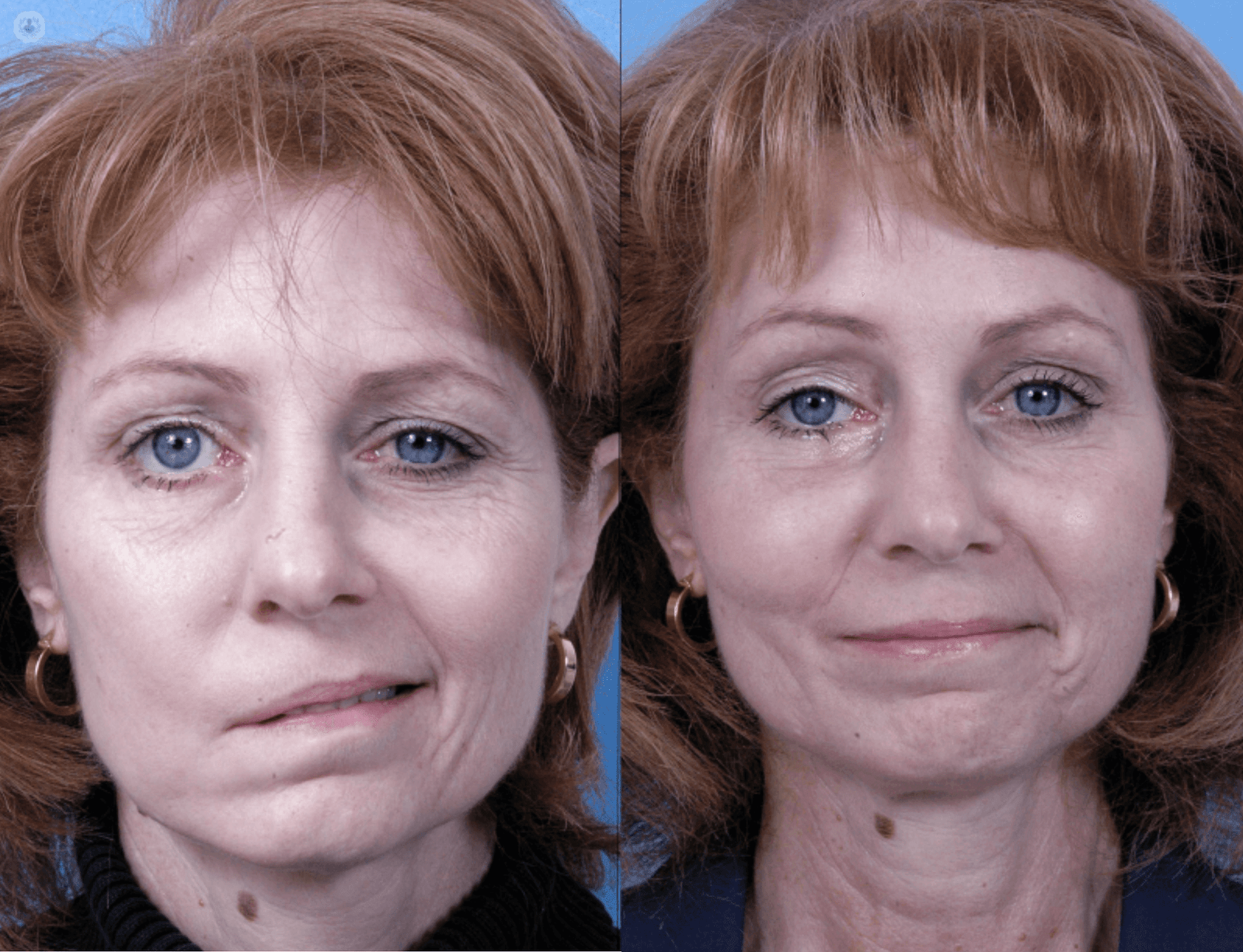 FacialParalysis
